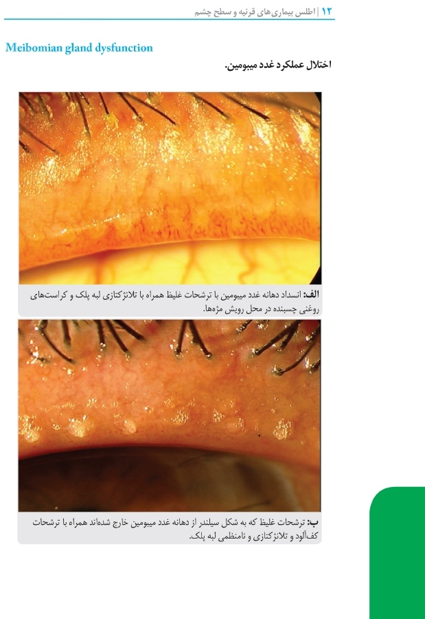 اطلس بیماری های قرنیه و سطح چشم